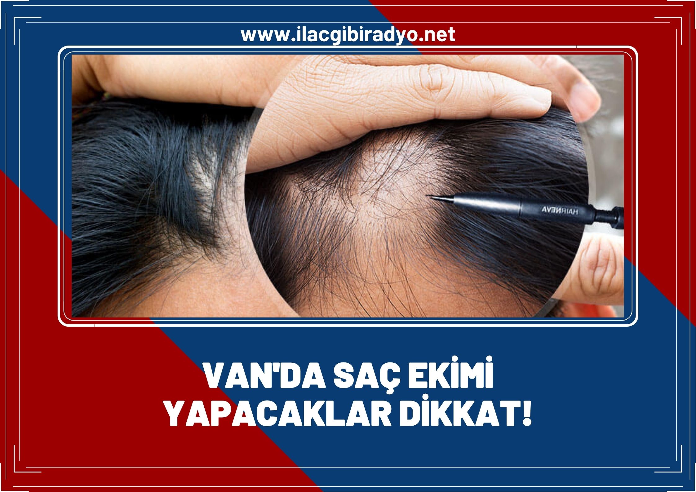 Van'da saç ekimi yapacaklar dikkat!